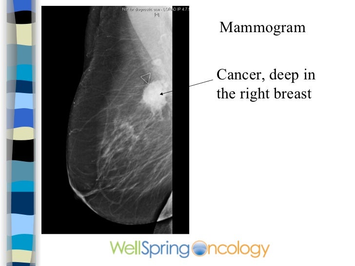 deep breast cancer Moby dick swallowed